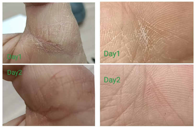 真实案例分享:手部湿疹困扰是如何缓解的